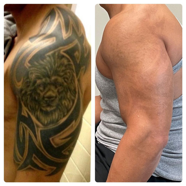 دستگاه لیزر کیوسوئیچ انزو