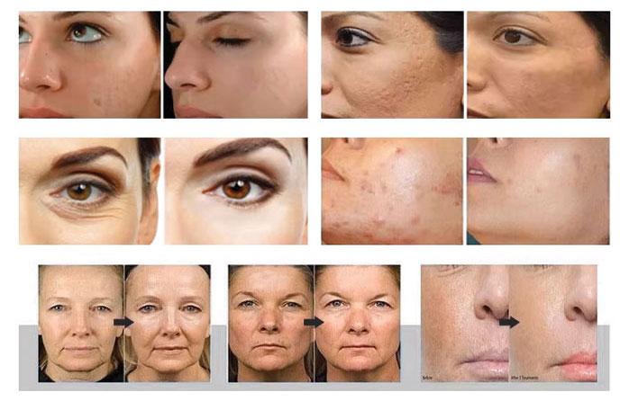 دستگاه آراف فرکشنال سوزنی کریستال لایت